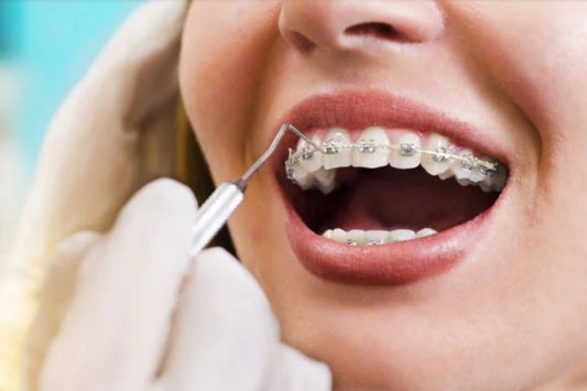 Cost of Braces in Canada: What You Need To Know