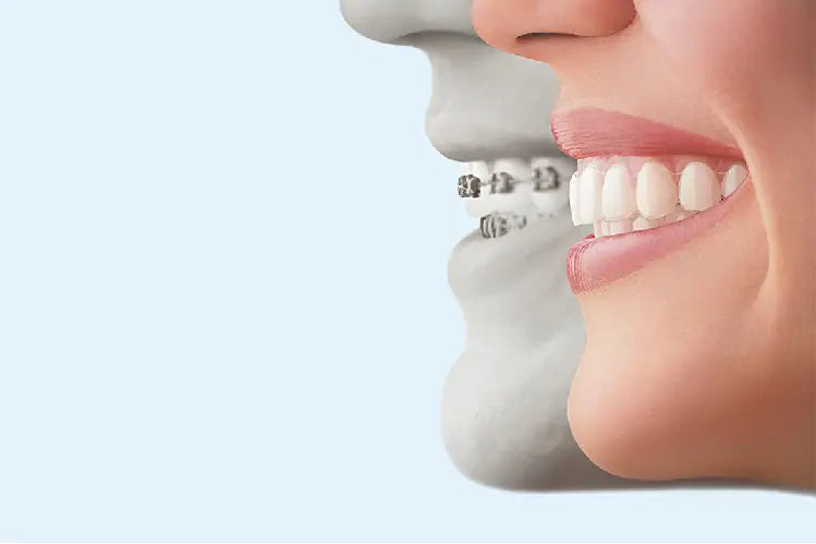 A comparative image of a girl with clear aligners vs braces