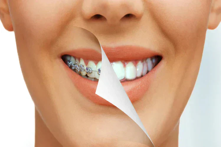 An image of a woman smiling and displaying what teeth look like with aligners vs. braces