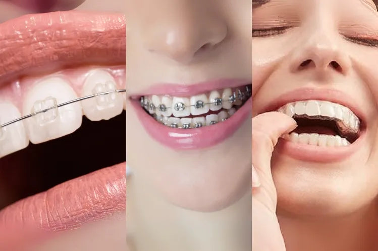 An image showing Clear Aligners, Ceramic Braces, and Metal Braces.