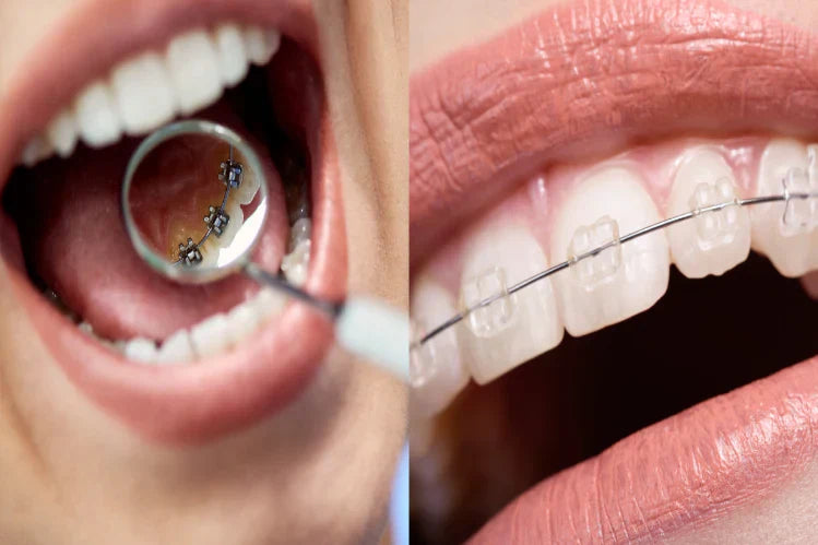 ceramic-braces-vs-lingual-braces