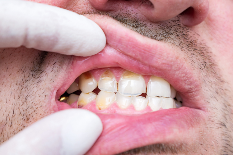 A man showing damage due to brittle teeth