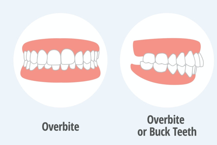 Transform Your Smile with Overbite Correction  Achieve a Confident,  Aligned Bite – Ortho Path