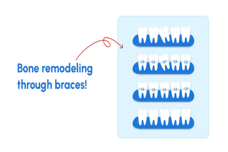 An image of straightening teeth through braces