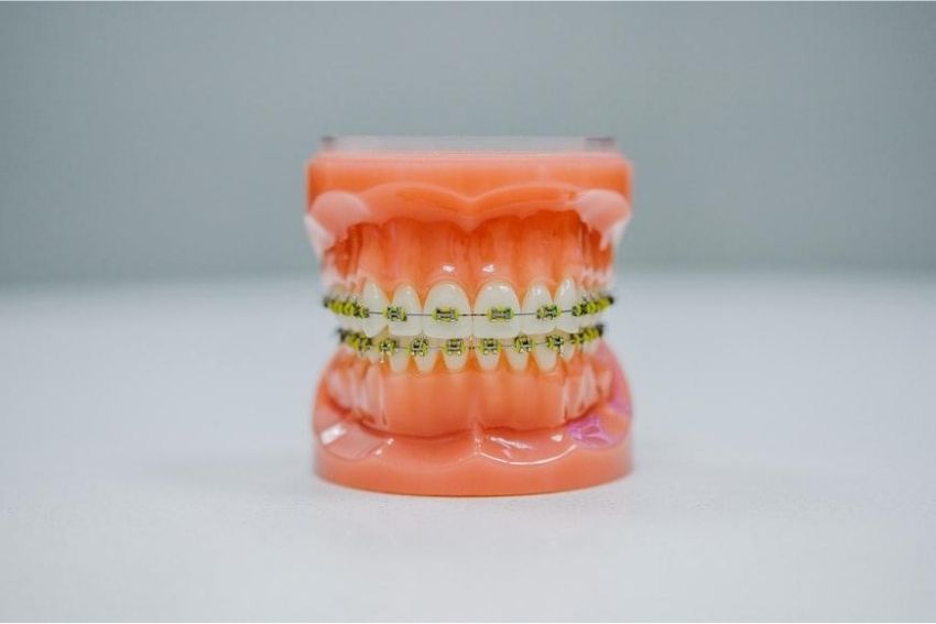 How Long Do Braces Hurt After Getting Them On?