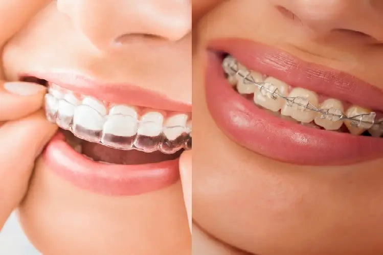 An image of a woman wearing invisible braces on the left and clear braces on the right
