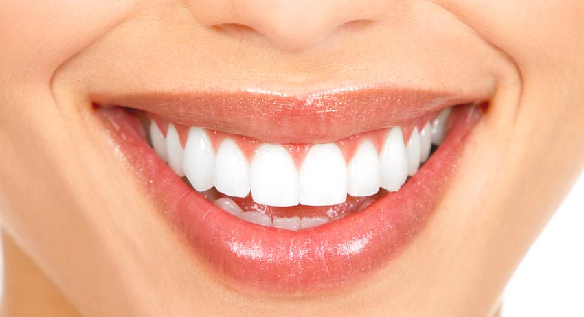 Is Bonding As Good As Veneers?