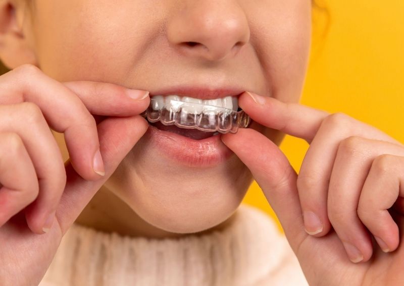 Metal vs. Ceramic Braces