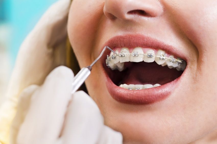 http://alignerco.ca/cdn/shop/articles/The-Cost-of-Braces-in-Canada-What-You-Need-To-Know.jpg?v=1677918033