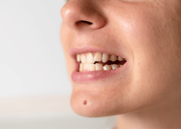 Can clear aligners fix crowded teeth?
