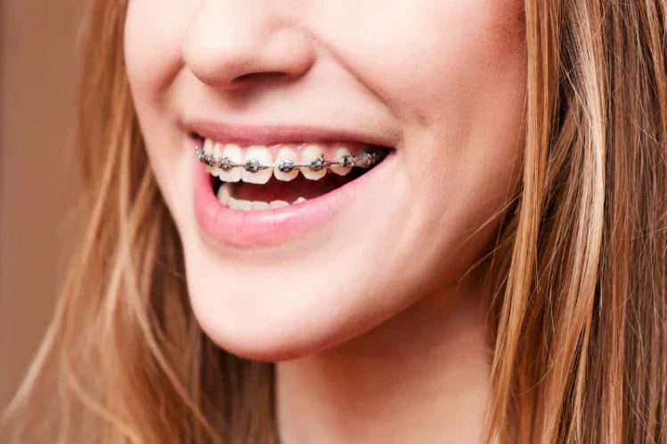A girl smiling with metal braces.