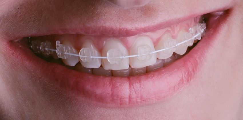 What Type of Clear Braces Are the Best?