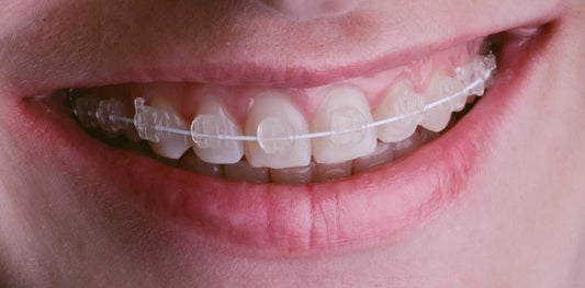 What Type of Clear Braces Are the Best