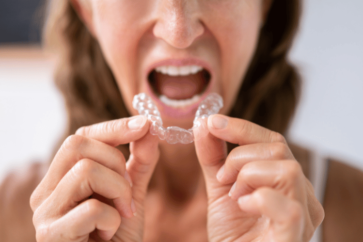 A Convenient Solution for Straightening Teeth