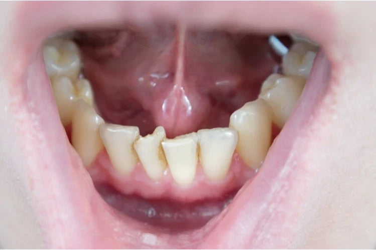 Crooked bottom teeth