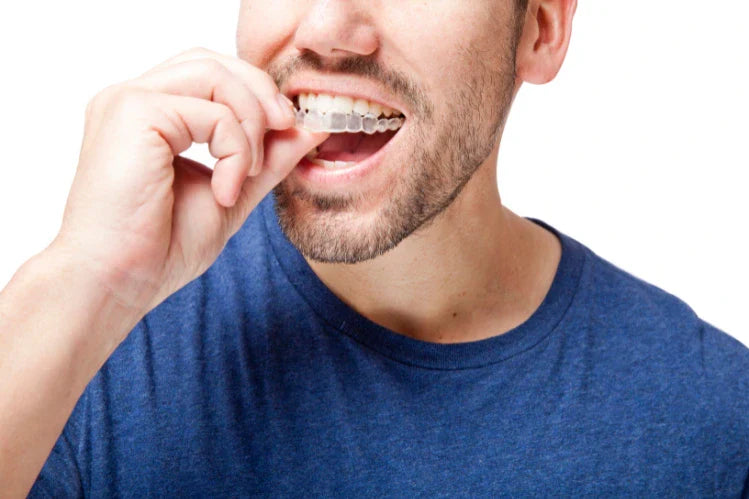 clear aligners