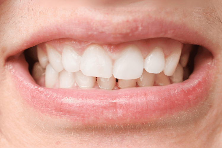 Correcting Teeth Alignment