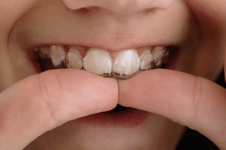 Retainer for teeth straightening