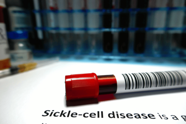 Oral Health Tips for Those with Sickle Cell Disease