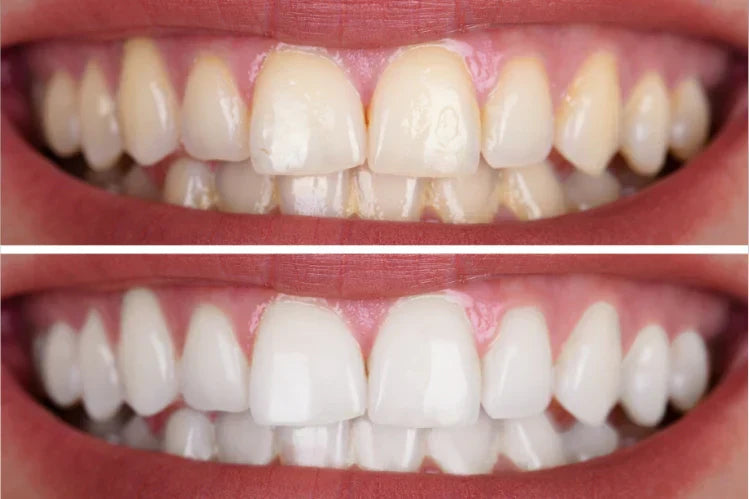 woman-teeth-before-and-after-whitening