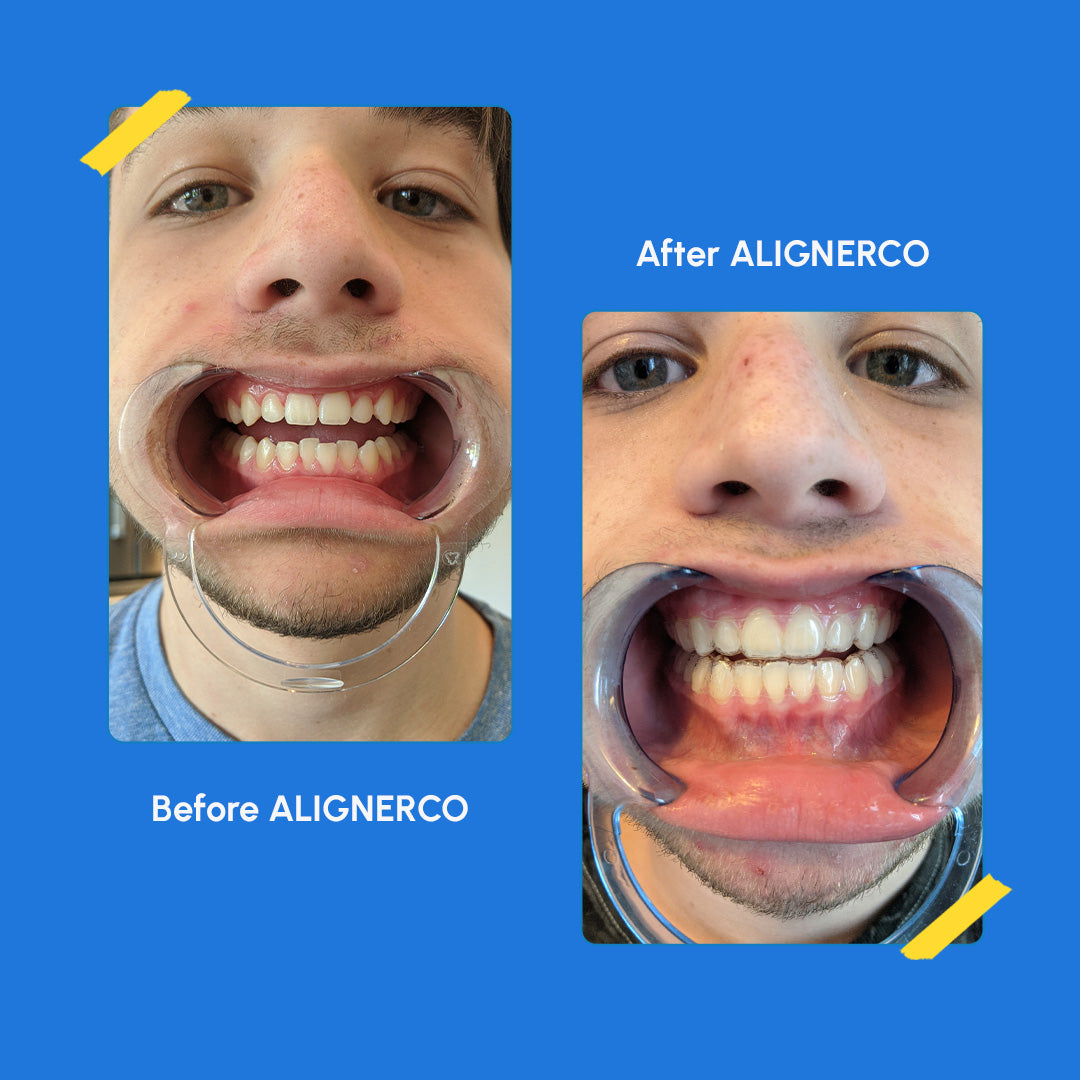Before and after smile transformation with ALIGNERCO clear aligners