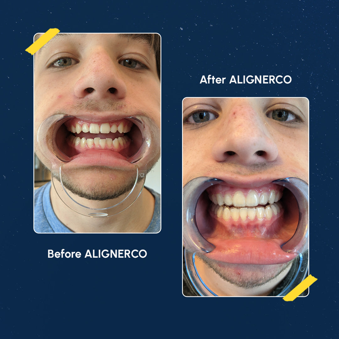 Alignerco
