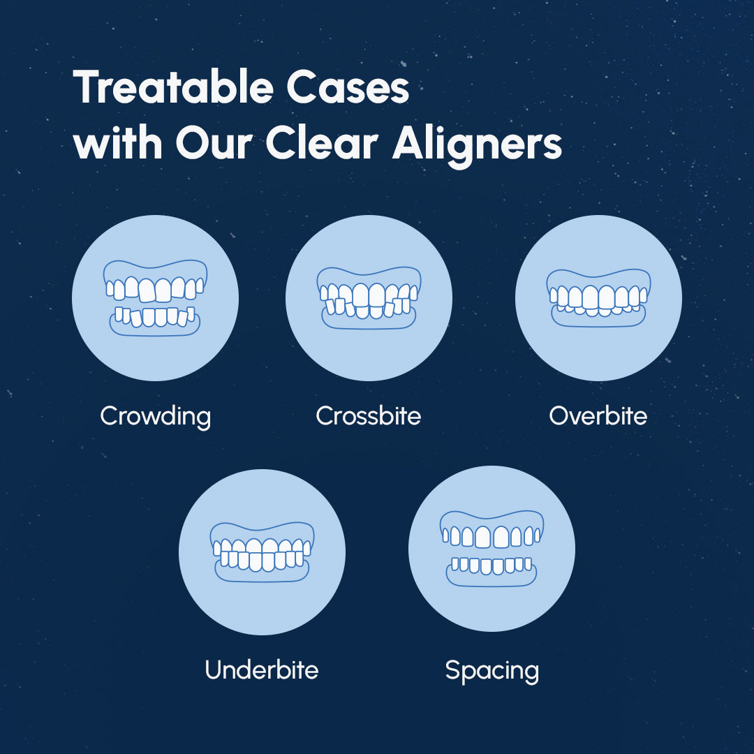Clear Aligners