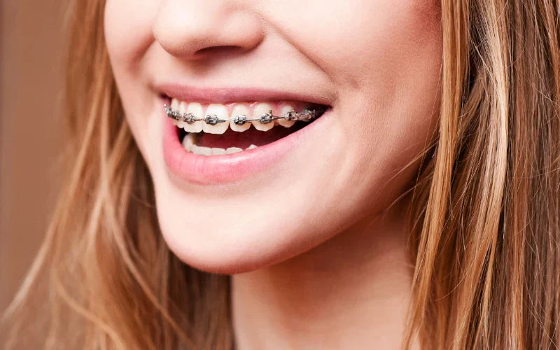 smelly retainers