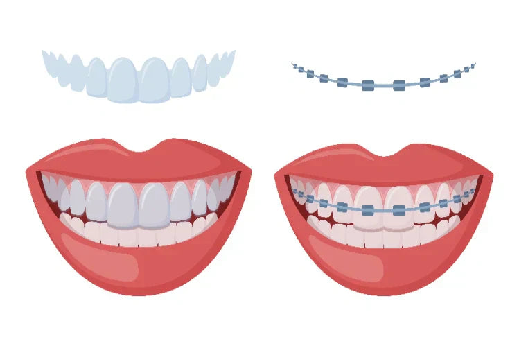illustration explaining what clear aligners and braces look like