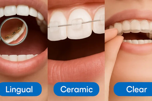  A side-by-side comparison of aligners, ceramic braces, and lingual braces 