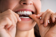 Overcorrection Aligners: Are They The Same as Clear Aligners?