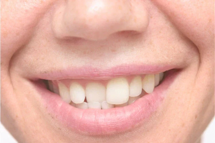 A close-up image of slanted front teeth