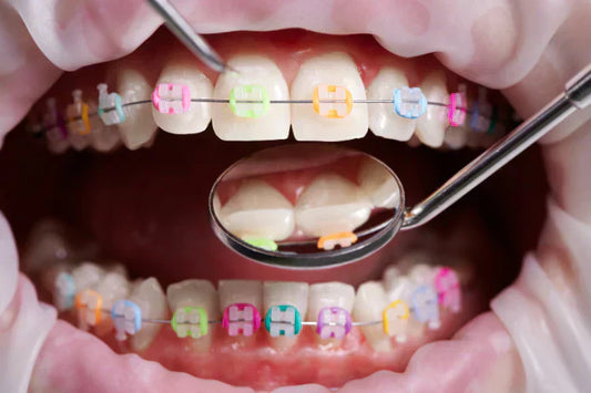 A close-up of teeth with colorful braces