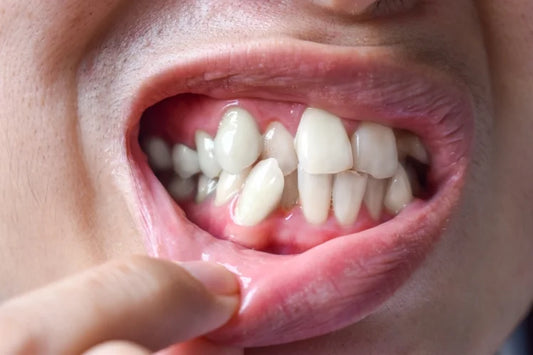 Overlapped teeth