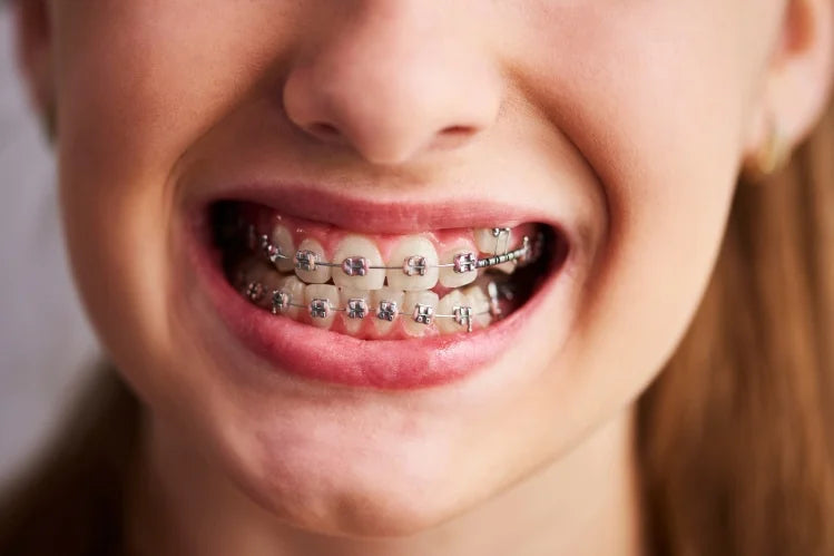 A person with metal braces showing their teeth