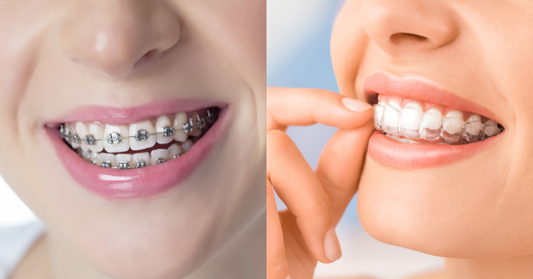  A side-by-side comparison of traditional braces and clear aligners