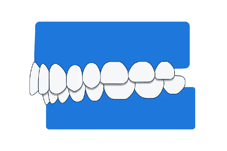 An illustration showing a class 2 bite