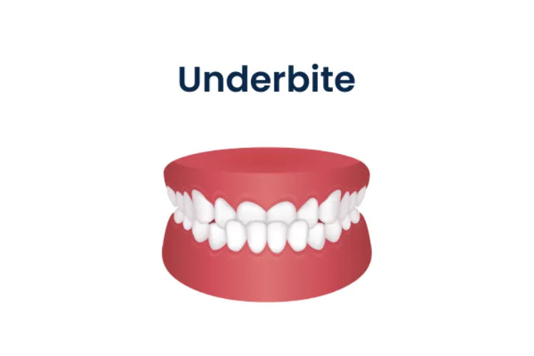 An illustration showing a dental underbite.