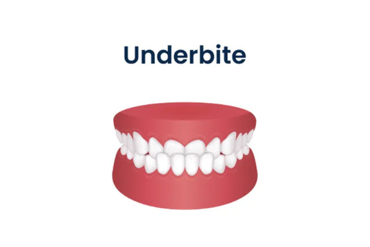 An illustration showing a dental underbite.