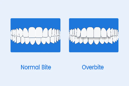 An illustration showing normal bite vs overbite