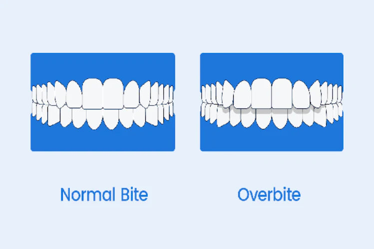 An illustration showing normal bite vs overbite