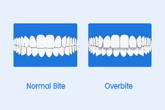Overbite vs Normal Bite: What’s the Difference and Why It Matters