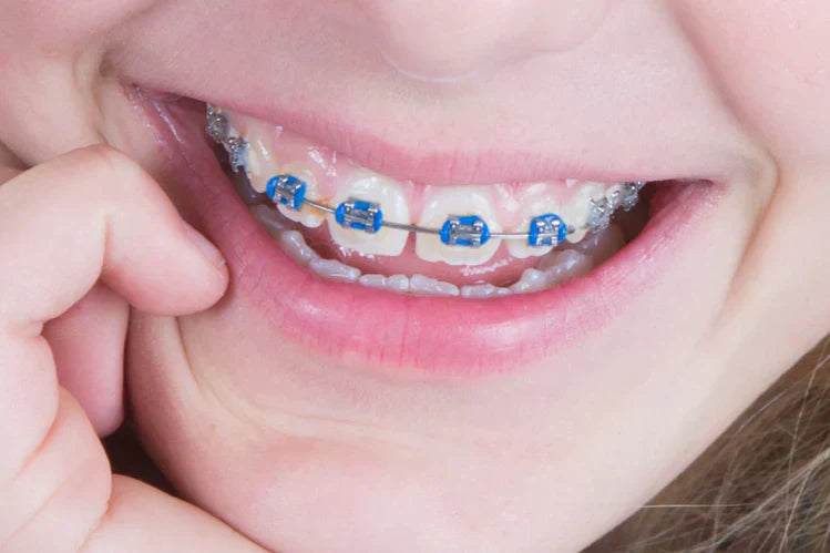 A close-up of a girl smiling with blue braces