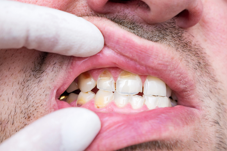 A man showing damage due to brittle teeth