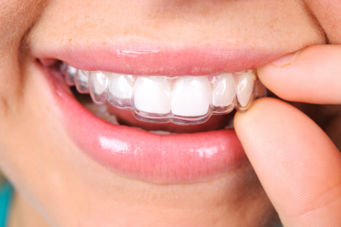 Can Retainers Fix Your Overbite?