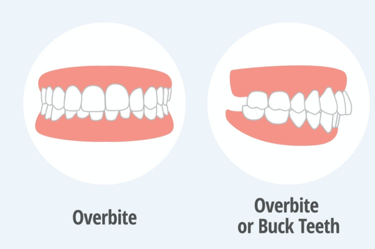 Overbite Issue