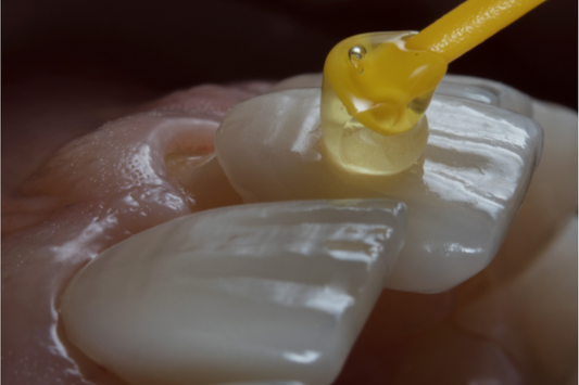 Close-up of porcelain veneers being placed on teeth