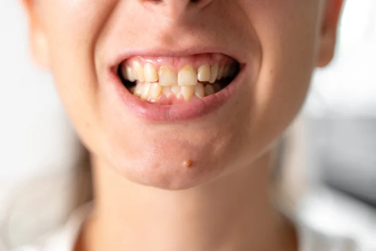 A girl holding clear aligners