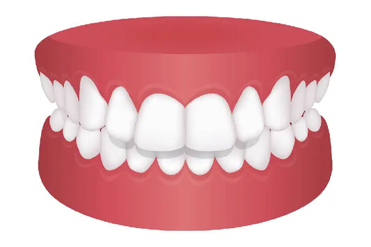 A 3D teeth model represents deep bite