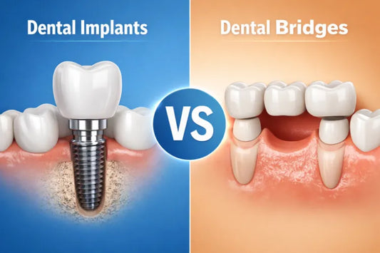 An illustration of dental implants vs. bridges 